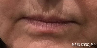 Lip Filler Before & After Gallery - Patient 5070427 - Image 1