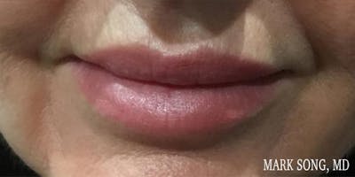 Lip Filler Before & After Gallery - Patient 5070427 - Image 2