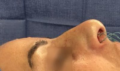 Functional Rhinoplasty Before & After Gallery - Patient 5070439 - Image 1