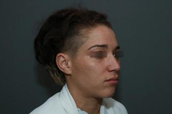 Functional Rhinoplasty Before & After Gallery - Patient 5070453 - Image 5
