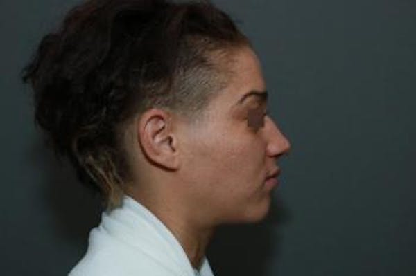 Functional Rhinoplasty Before & After Gallery - Patient 5070453 - Image 9