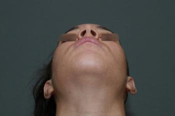 Functional Rhinoplasty Before & After Gallery - Patient 5070453 - Image 11