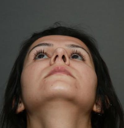 Functional Rhinoplasty Before & After Gallery - Patient 5070465 - Image 1