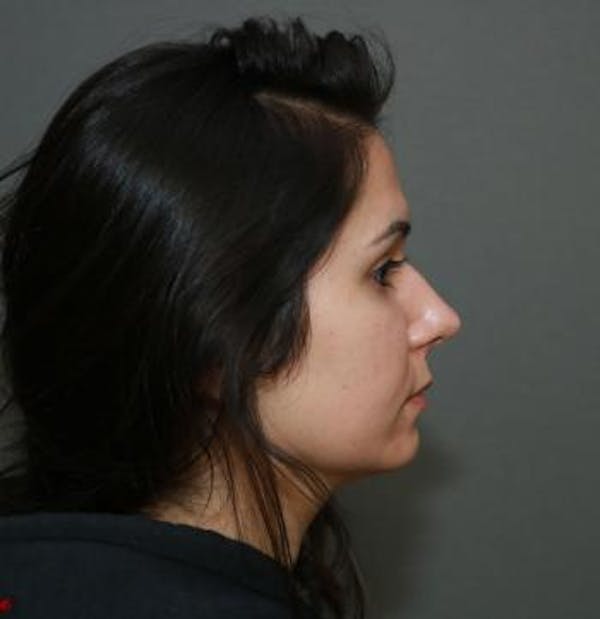 Functional Rhinoplasty Before & After Gallery - Patient 5070465 - Image 3