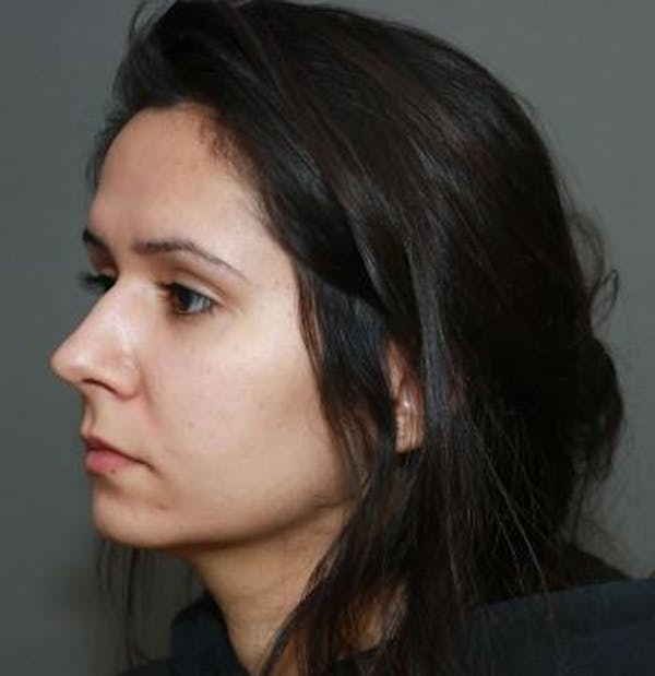 Functional Rhinoplasty Before & After Gallery - Patient 5070465 - Image 5