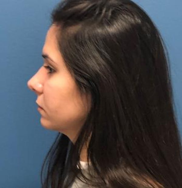 Functional Rhinoplasty Before & After Gallery - Patient 5070465 - Image 6