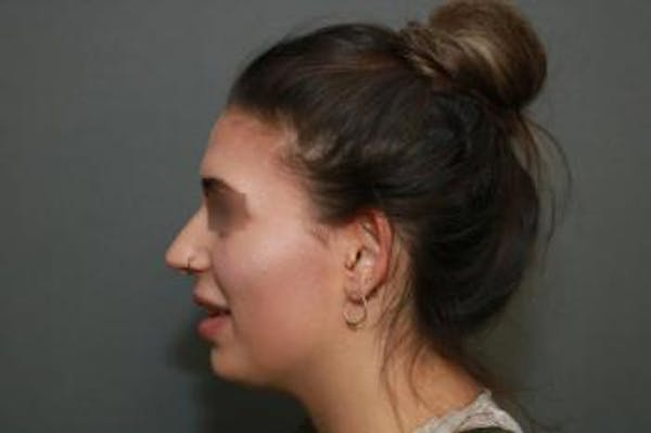 Aesthetic Rhinoplasty Before & After Gallery - Patient 5070476 - Image 5