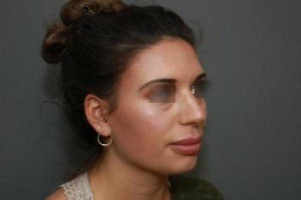 Aesthetic Rhinoplasty Before & After Gallery - Patient 5070476 - Image 7
