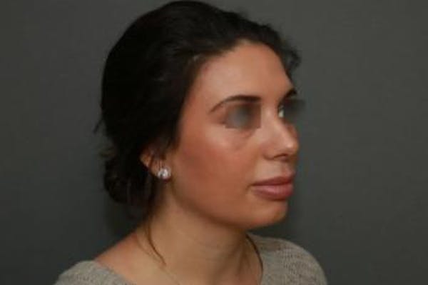 Aesthetic Rhinoplasty Before & After Gallery - Patient 5070476 - Image 8