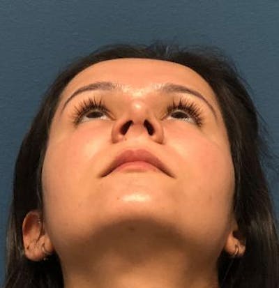 Aesthetic Rhinoplasty Before & After Gallery - Patient 5070483 - Image 4
