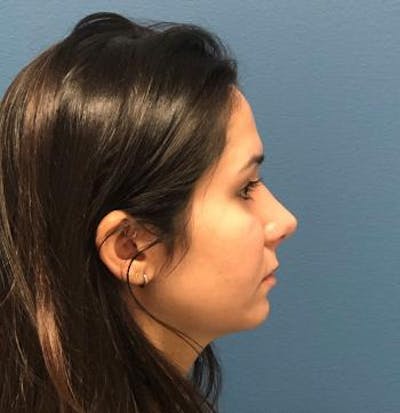 Aesthetic Rhinoplasty Before & After Gallery - Patient 5070483 - Image 6