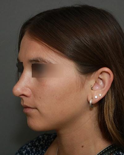 Aesthetic Rhinoplasty Before & After Gallery - Patient 5070488 - Image 4