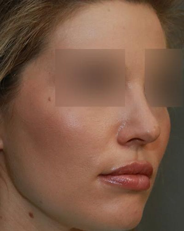 Aesthetic Rhinoplasty Before & After Gallery - Patient 5070495 - Image 3