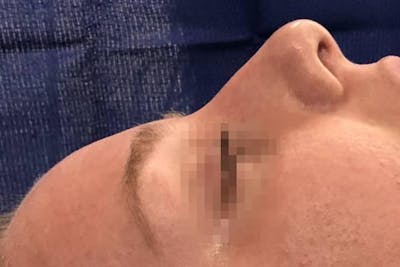 Aesthetic Rhinoplasty Before & After Gallery - Patient 5070499 - Image 1