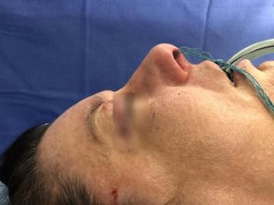 Aesthetic Rhinoplasty Before & After Gallery - Patient 5070504 - Image 1