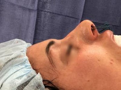 Aesthetic Rhinoplasty Before & After Gallery - Patient 5070508 - Image 1