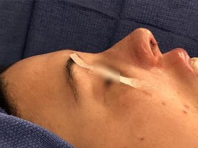 Aesthetic Rhinoplasty Before & After Gallery - Patient 5070508 - Image 2