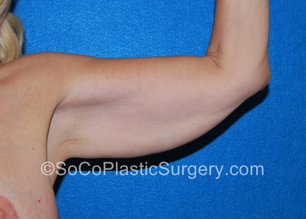 Brachioplasty Before & After Gallery - Patient 5070694 - Image 3
