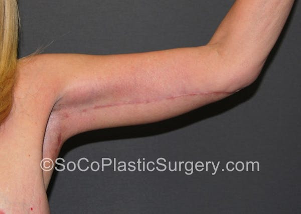 Brachioplasty Before & After Gallery - Patient 5070694 - Image 4