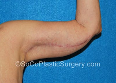 Brachioplasty Before & After Gallery - Patient 5070714 - Image 2
