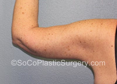 Brachioplasty Before & After Gallery - Patient 5070718 - Image 4
