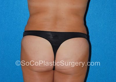 Brazilian Butt Lift Before & After Gallery - Patient 5070765 - Image 2