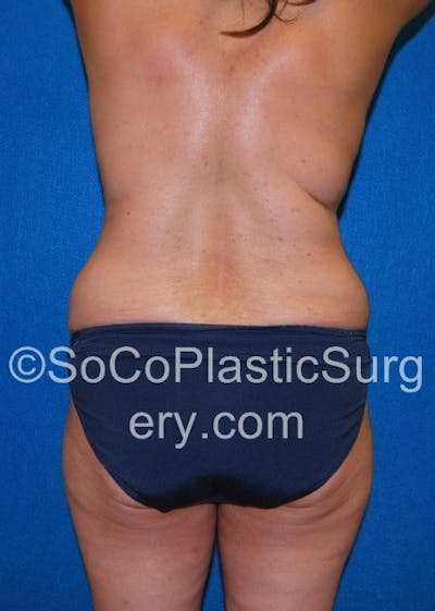 Tummy Tuck Before & After Gallery - Patient 5088907 - Image 1
