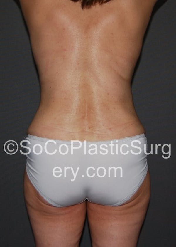 Tummy Tuck Before & After Gallery - Patient 5088907 - Image 2