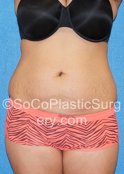 Tummy Tuck Before & After Gallery - Patient 5088994 - Image 1