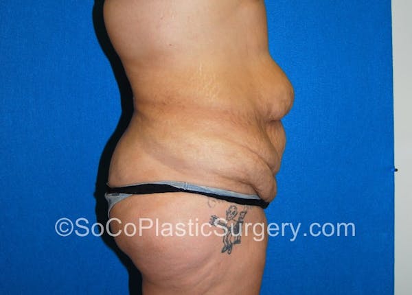 Tummy Tuck Before & After Gallery - Patient 5089235 - Image 5