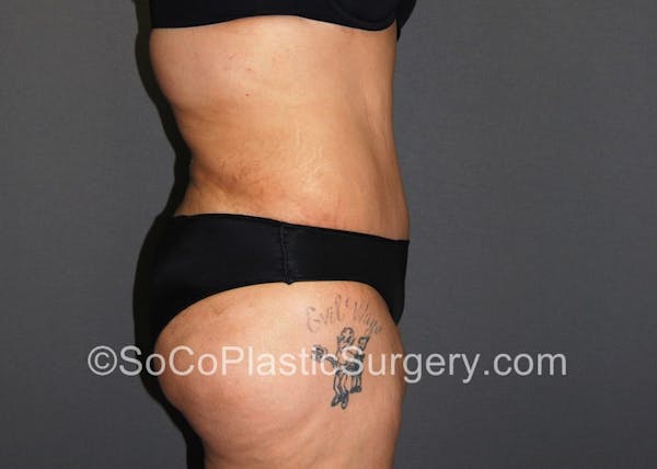 Tummy Tuck Before & After Gallery - Patient 5089235 - Image 6