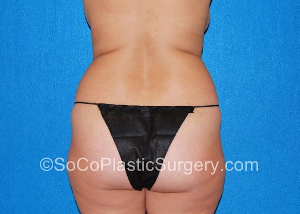 Tummy Tuck Before & After Gallery - Patient 5089485 - Image 7