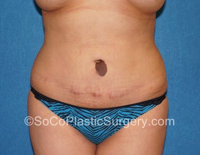 Tummy Tuck Before & After Gallery - Patient 5089546 - Image 1