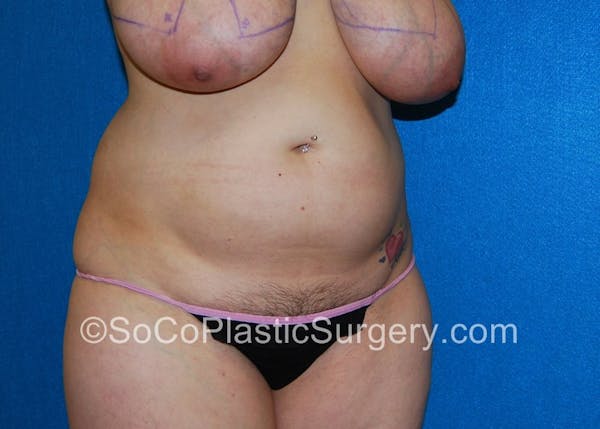 Tummy Tuck Before & After Gallery - Patient 5089578 - Image 3