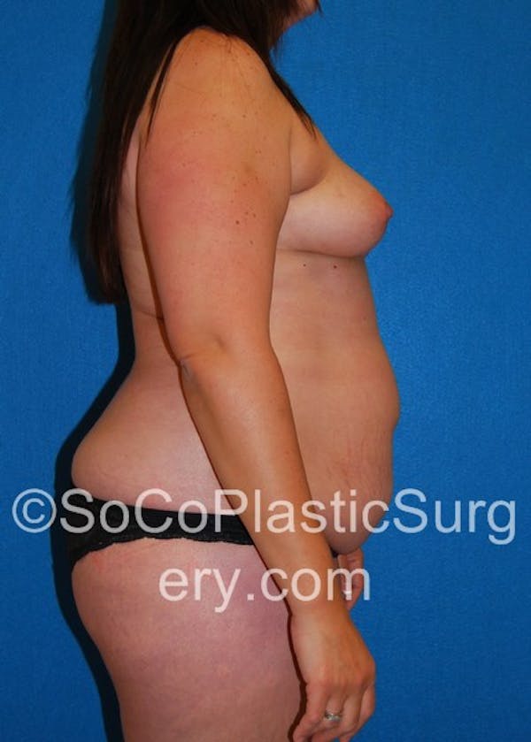 Mommy Makeover Before & After Gallery - Patient 5089938 - Image 5