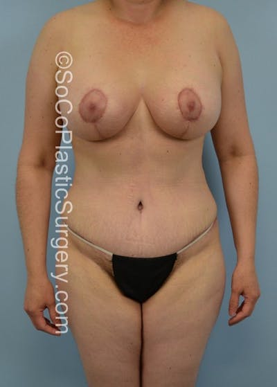 Mommy Makeover Before & After Gallery - Patient 5090187 - Image 2