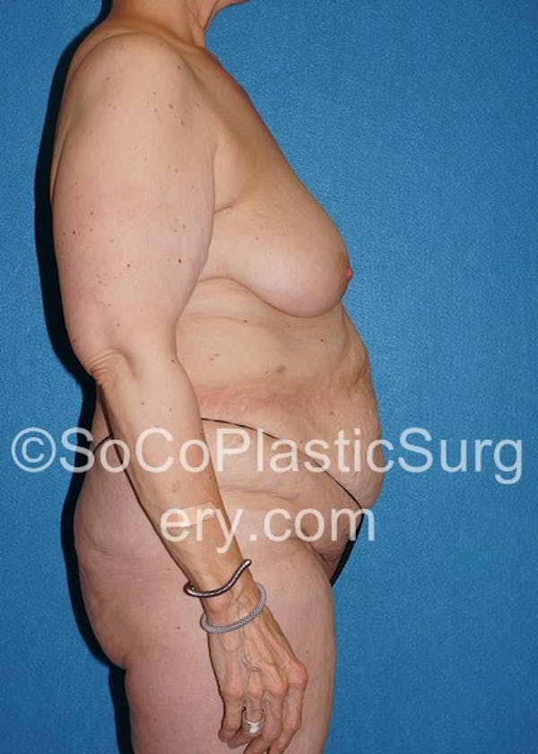 Mommy Makeover Before & After Gallery - Patient 5090263 - Image 5