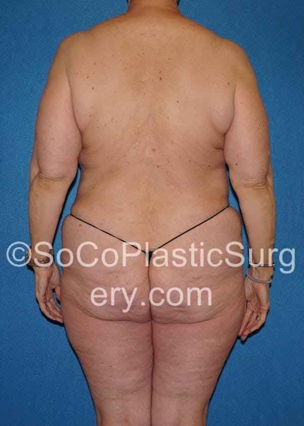 Mommy Makeover Before & After Gallery - Patient 5090263 - Image 7