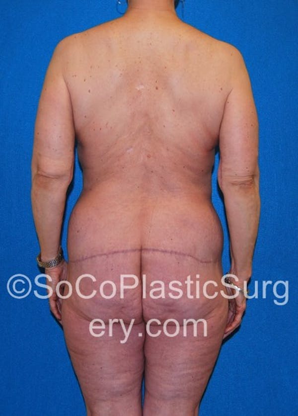 Mommy Makeover Before & After Gallery - Patient 5090263 - Image 8