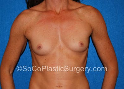Breast Augmentation Before & After Gallery - Patient 5090559 - Image 1