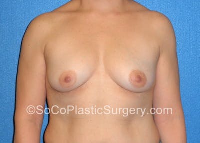 Breast Augmentation Before & After Gallery - Patient 5090988 - Image 1