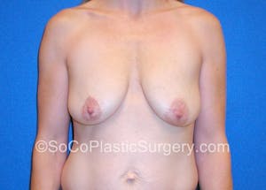 Close up on Before and After Breast Lift in Irvine