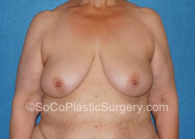 Breast Lift Before & After Gallery - Patient 5091696 - Image 1