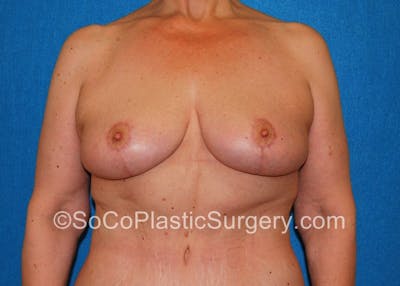 Breast Lift Before & After Gallery - Patient 5091696 - Image 2