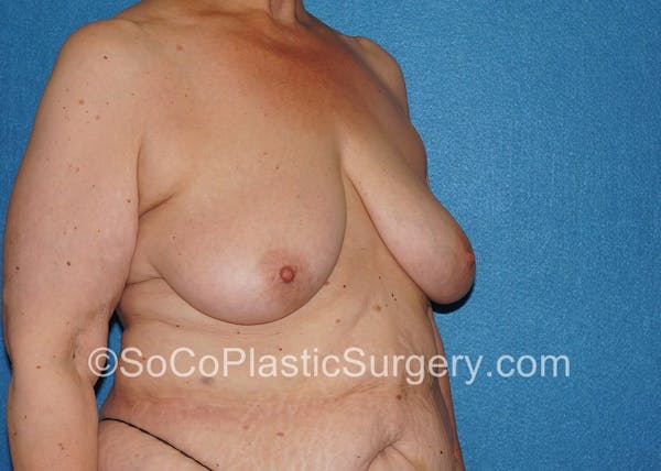 Breast Lift Before & After Gallery - Patient 5091696 - Image 3