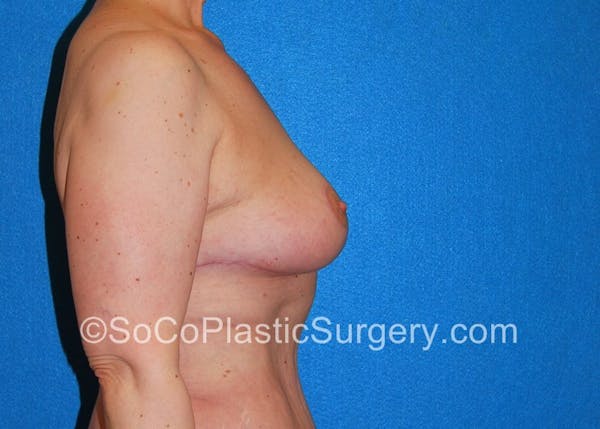 Breast Lift Before & After Gallery - Patient 5091696 - Image 6