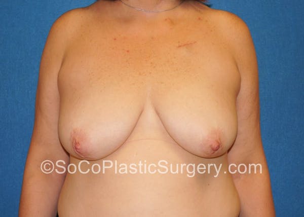 Breast Lift Before & After Gallery - Patient 5091817 - Image 1