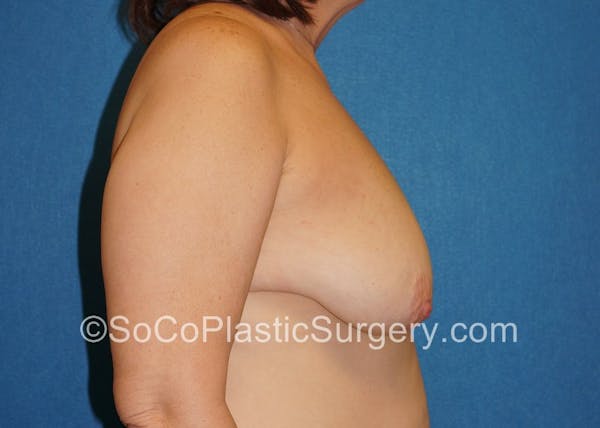 Breast Lift Before & After Gallery - Patient 5091817 - Image 5