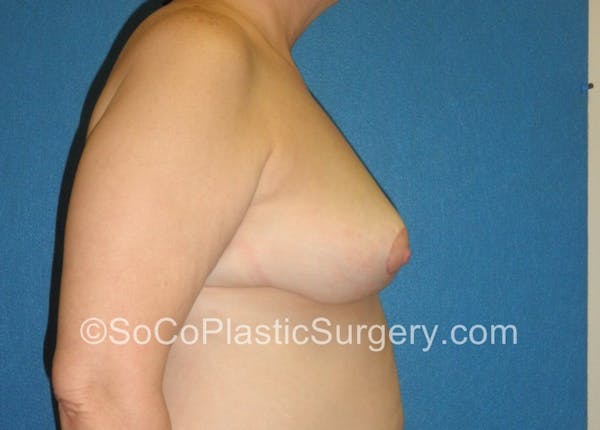 Breast Lift Before & After Gallery - Patient 5091817 - Image 6