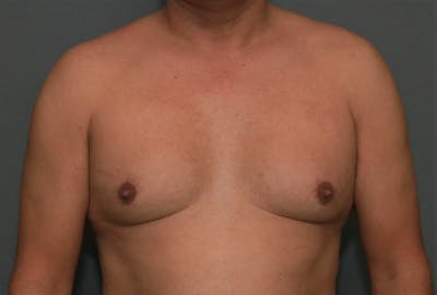 Gynecomastia Before & After Gallery - Patient 8284596 - Image 1